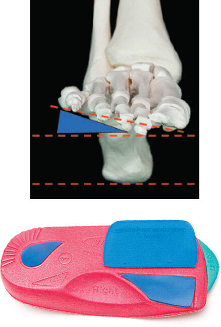 Vasyli Forefoot Wedges - Varus and Valgus Correction Options for Forefoot Abnormalities