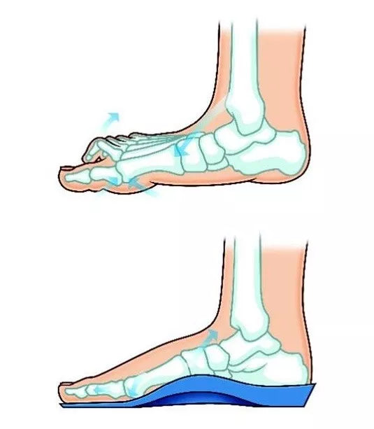 Talarmade Elevate - Firm Density, Heat Mouldable Modular Orthotic Kit for Customised Patient Fit