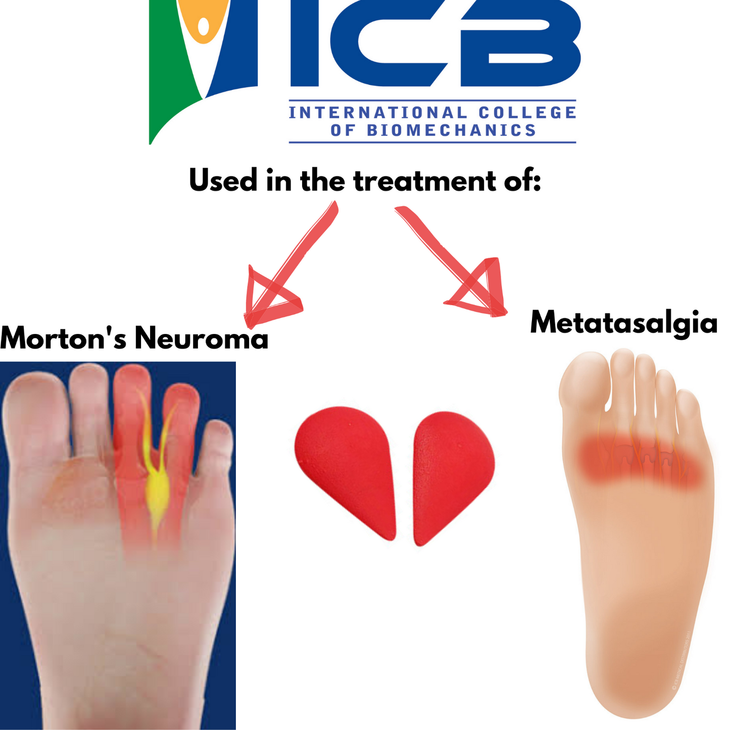 ICB Metatarsal Domes - Pack of 5 Pairs - Mortons Neuroma Treatment