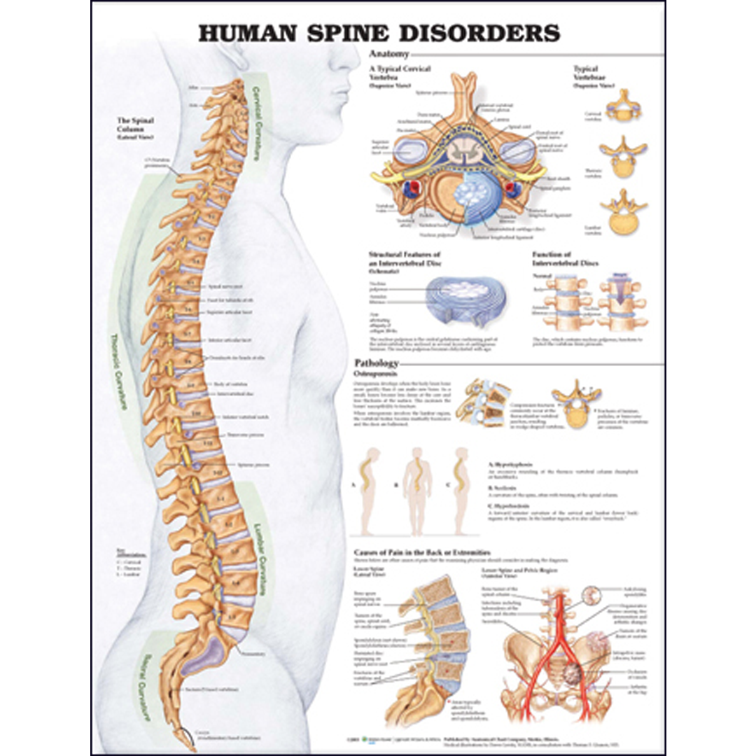 Human Spine Disorders Anatomical Chart Laminated - Ideal for Health Professionals & Students in Australia
