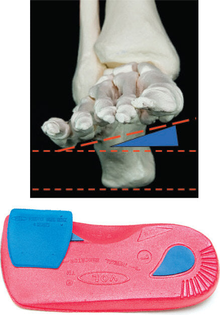 Vasyli Forefoot Wedges - Varus and Valgus Correction Options for Forefoot Abnormalities