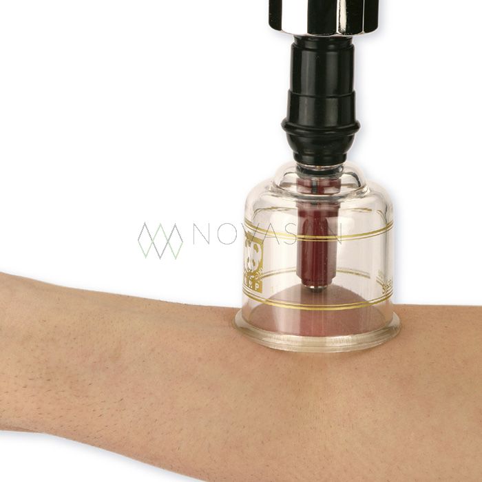 PLASTIC CUPPING SUCTION SET